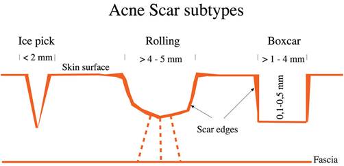 Acne-Scars1