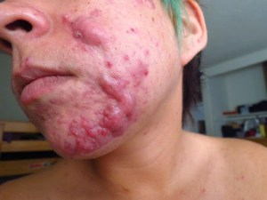 Cystic acne – larger pus filled lumps