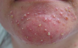 Pustular acne – the presence of yellowish liquid pus in the acne