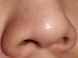 whitehead blackhead