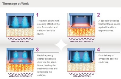 Thermage-CPT-technology-400x264